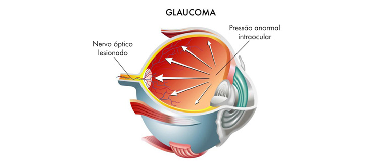 Glaucoma